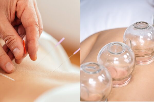 acupuncture